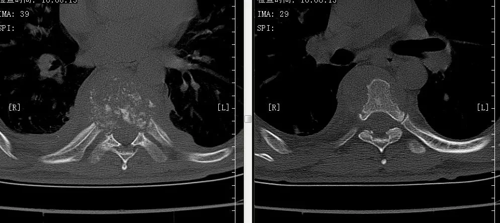 二一五医院骨科医院脊柱外科成功治疗一名胸椎结核患者|新冠肺炎_新浪