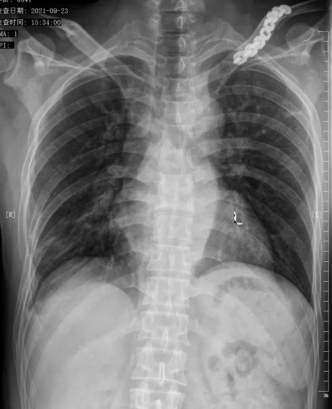 二一五医院骨科医院脊柱外科成功治疗一名胸椎结核患者