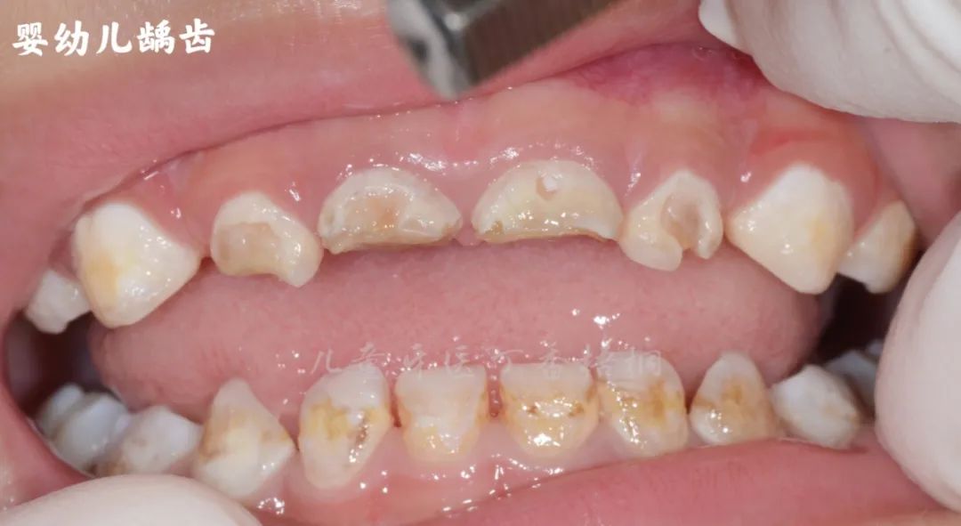 孩子到底几岁要戒掉奶瓶晚于这个时间危害可不止一点点