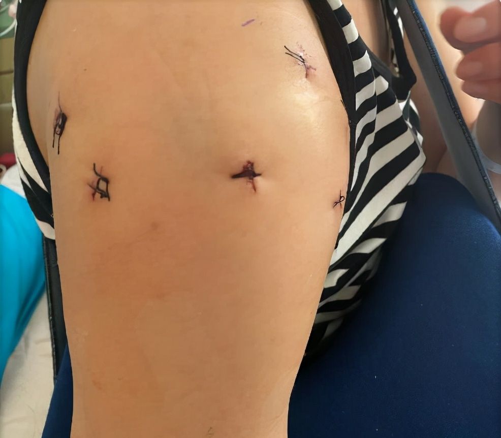 颜妮在北京做手术,右肩膀固定8颗钉子,手术进行了6个小时休闲区蓝鸢梦想 - Www.slyday.coM 颜妮在北京做手术,右肩膀固定8颗钉子,手术进行了6个小时休闲区蓝鸢梦想 - Www.slyday.coM