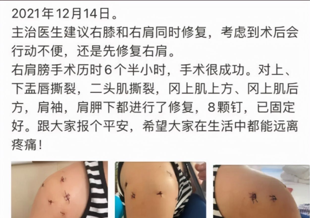 颜妮在北京做手术,右肩膀固定8颗钉子,手术进行了6个小时休闲区蓝鸢梦想 - Www.slyday.coM 颜妮在北京做手术,右肩膀固定8颗钉子,手术进行了6个小时休闲区蓝鸢梦想 - Www.slyday.coM