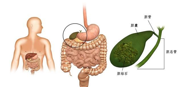 胆囊可有可无,切除胆囊对人体没啥影响?