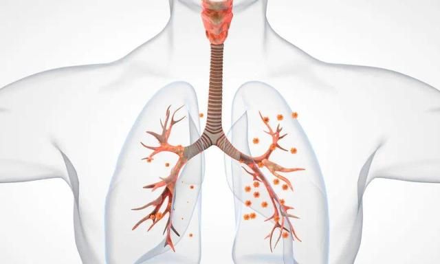 慢性支气管炎,是如何一步步危害人体的?医生终于说出了大实话__财经头