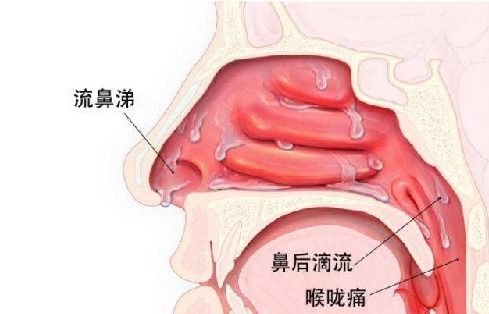 济南中医儿科杨晓孩子咳嗽久治不愈需警惕上气道咳嗽综合征