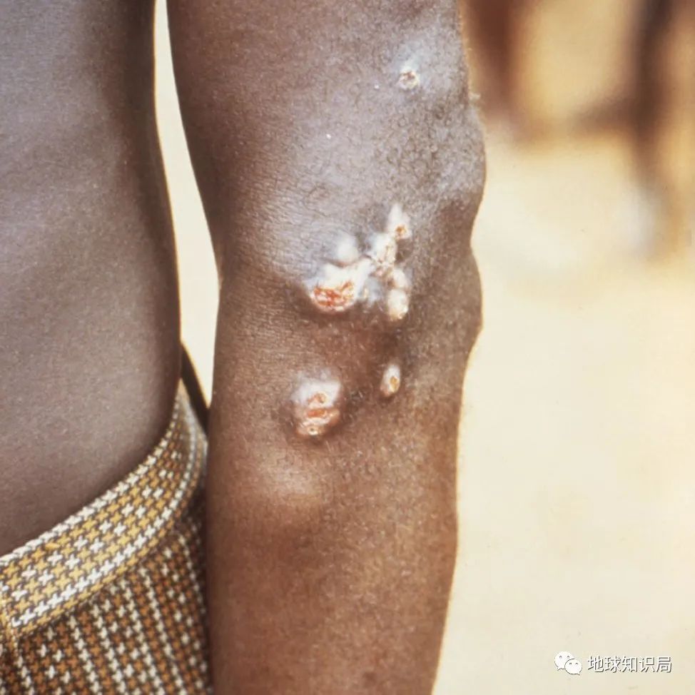 (图:wikipedia)▼感染雅司病的非洲土著,身上出现烂疮关于梅毒从何