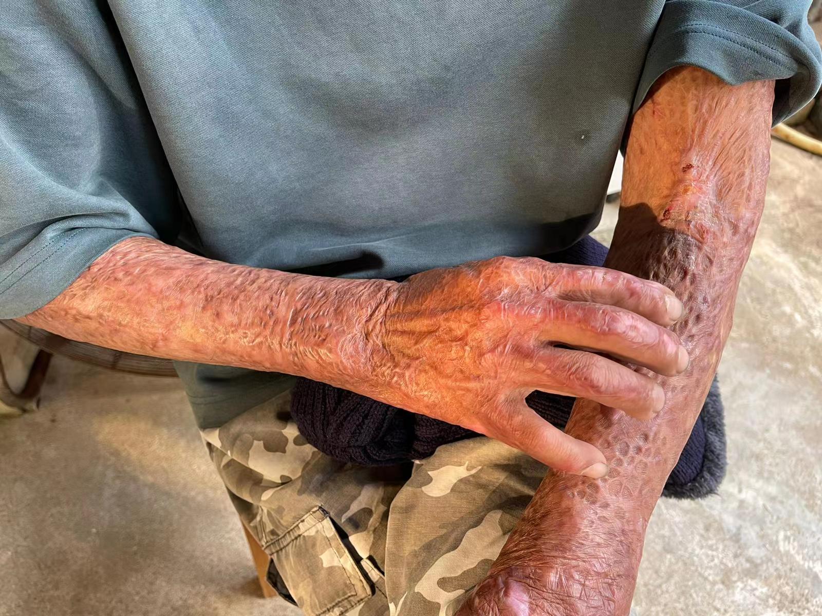 李伯烧伤的皮肤不时发痒,轻轻一抓就会流血