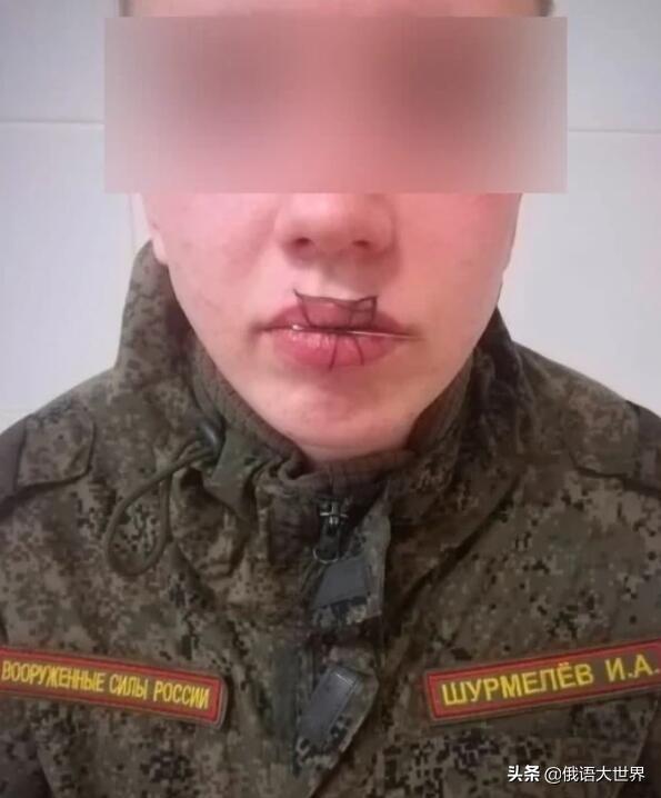 和女友吵完架,他把自己的嘴给缝上了