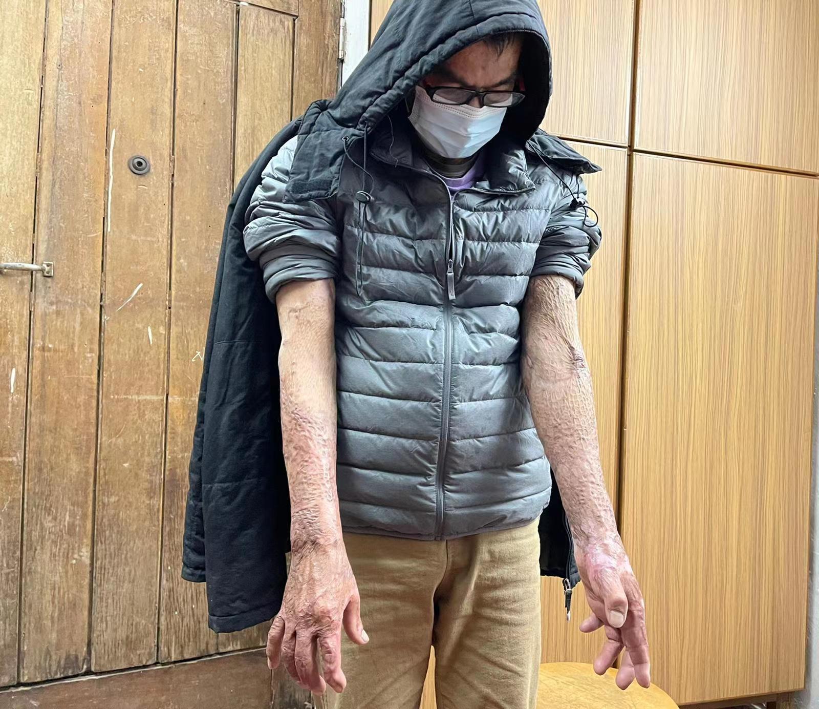 香江来信丨被暴徒火烧李伯不悔当初愿选出贤能爱国者治港