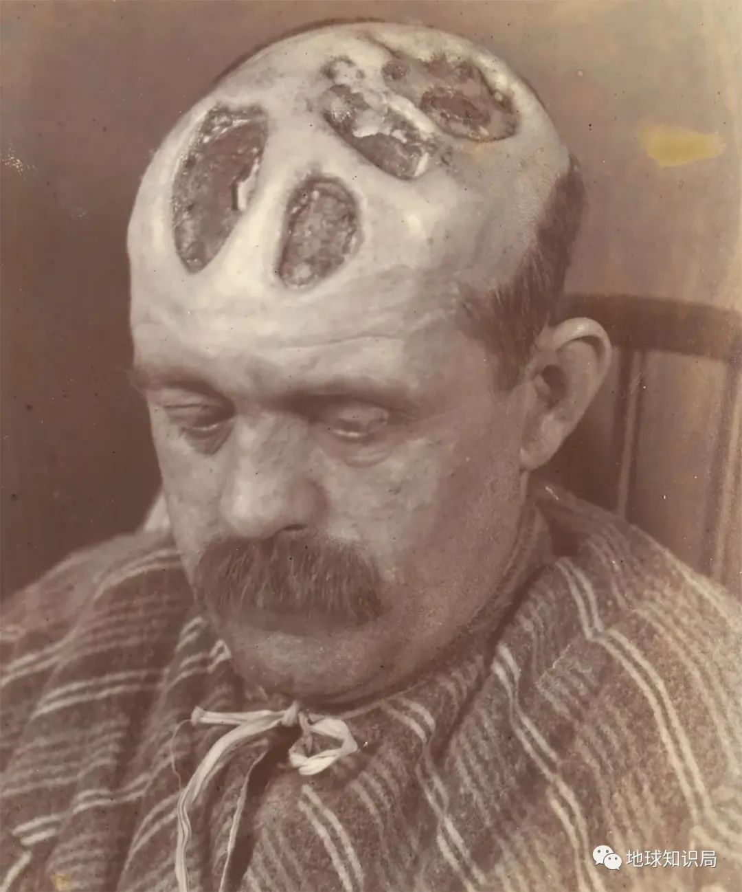 (图:wellcomecollection)▼晚期梅毒导致的骨组织病变,十分可怕然而