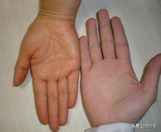 不过,大家可以放心的是,橘黄症除了皮肤发黄外,并没有其他特殊的身体