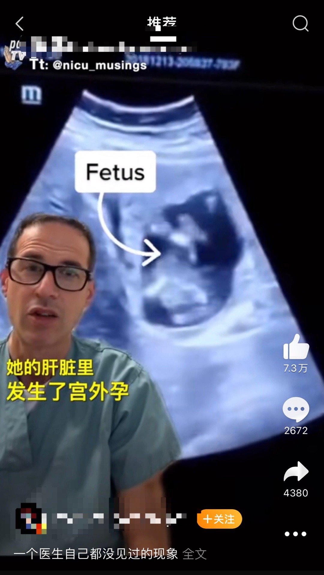 有粉丝让我看一个视频是发生在肝脏上的异位妊娠