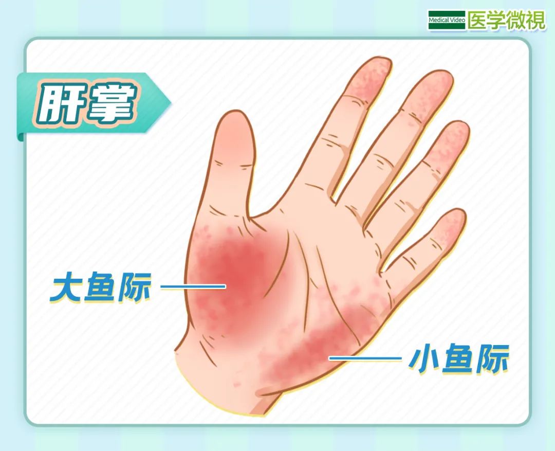 肝掌表现为手掌大鱼际,小鱼际的皮肤,出现粉红色或红色斑块,斑点,按压