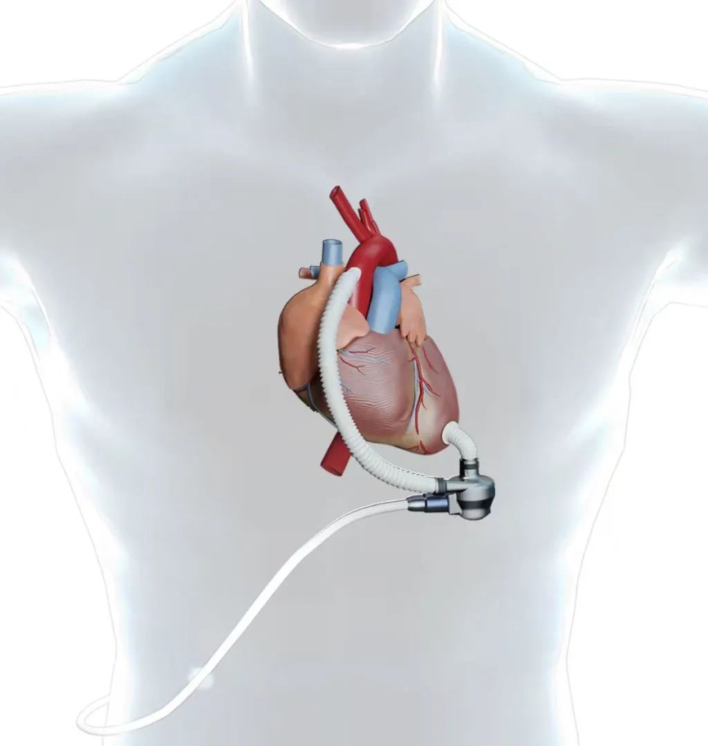 山东首例国产人工心脏植入手术顺利完成