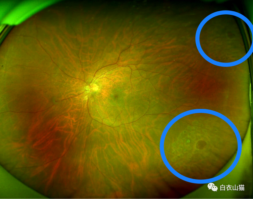 因为一些疾病或者使用不当,墙纸破了一个洞,这个洞就是视网膜裂孔(图1