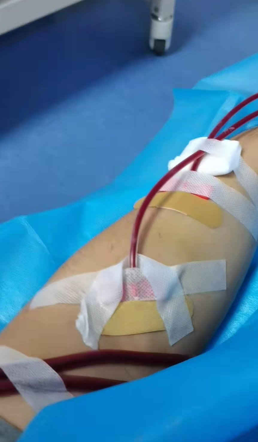 西安疫情封控区部分尿毒症患者已接受透析医疗救治组正陆续安排