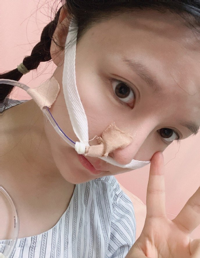 网红饭思思吃外卖戳破食管肺部感染做三次手术出院时仍插胃管