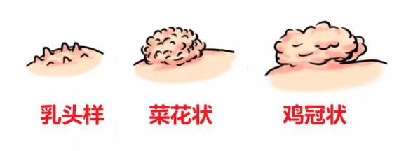 感染hpv会全身长满"菜花"?|尖锐湿疣|hpv|宫颈癌_新浪新闻