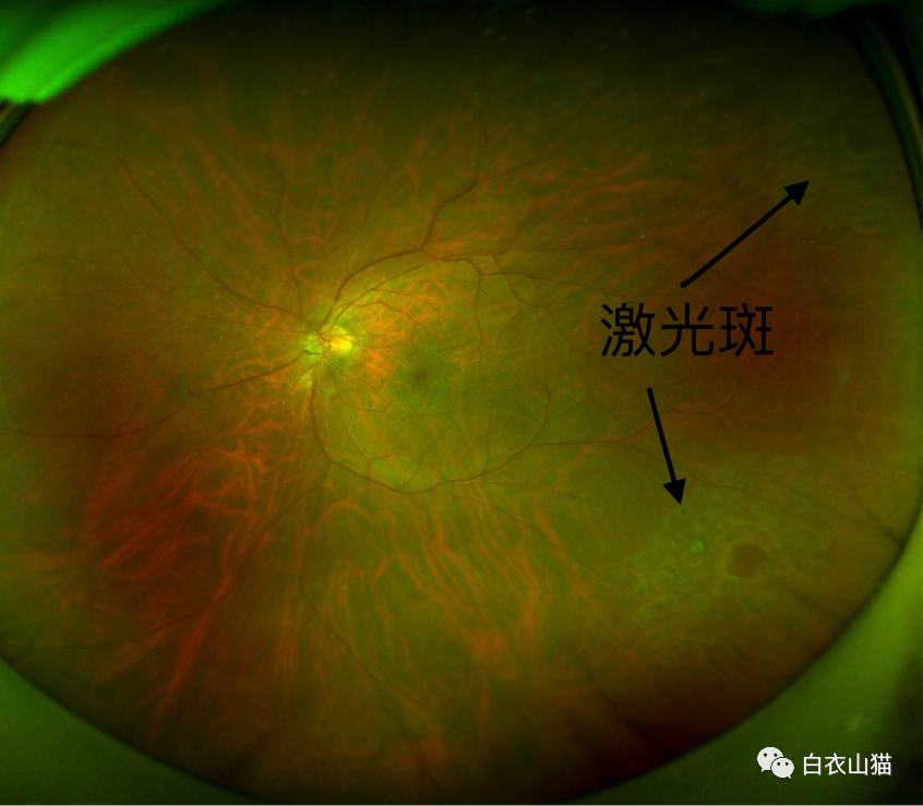 视网膜光镜图红蓝铅笔图片