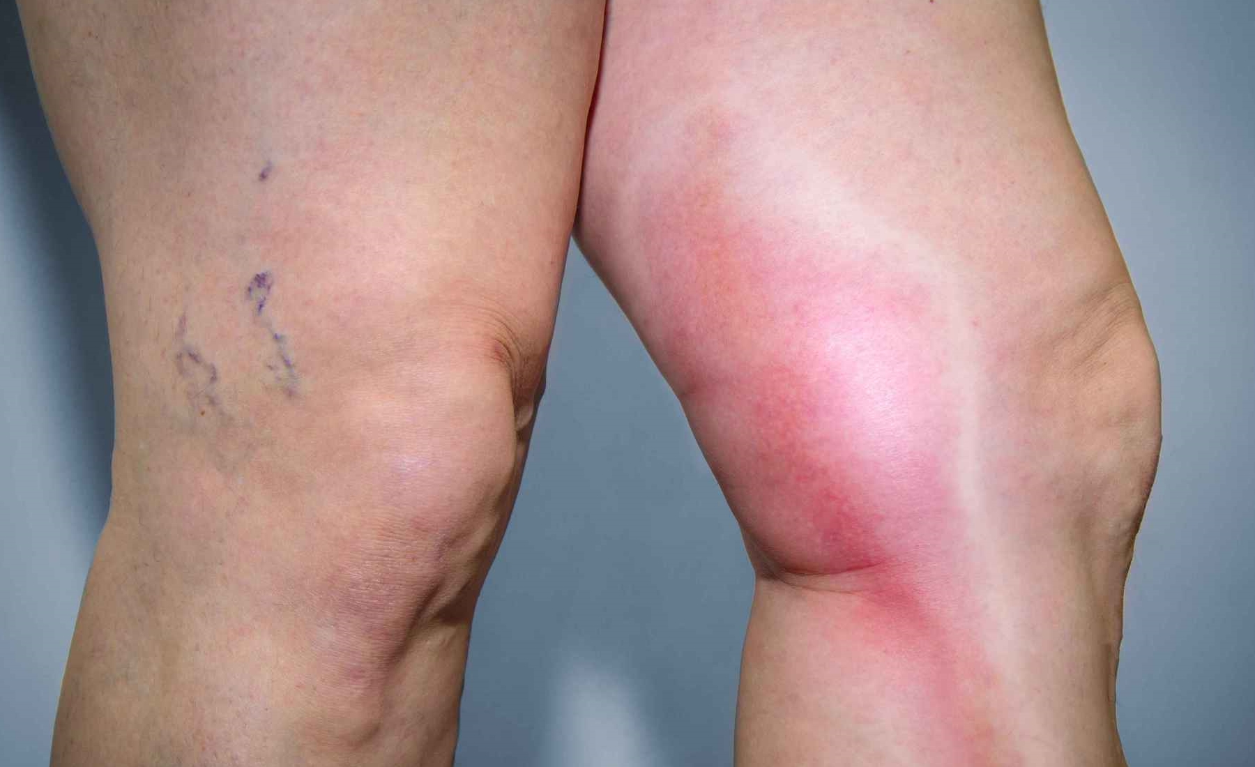 若腿部出现这4种现象暗示有血栓50岁的你赶紧做好这3件事