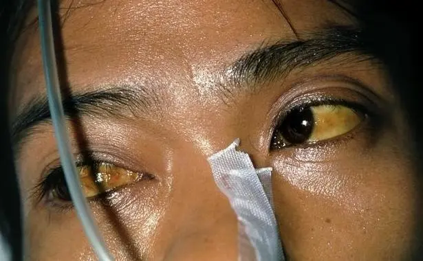 肝癌如果到了晚期,患者可能会出现全身发黄的表现.