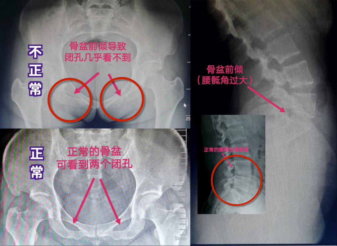 人不胖小肚子却突出当心骨盆前倾