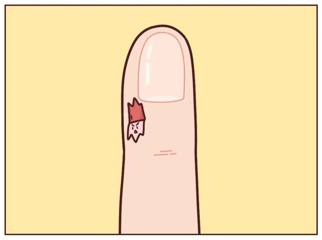 手指老长倒刺是缺维生素吗