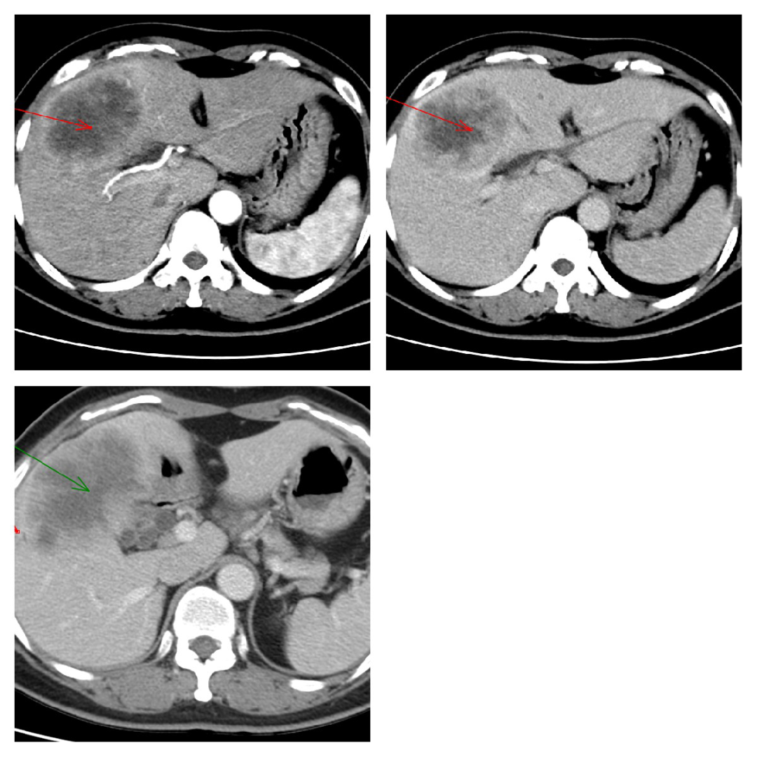 腹部（肝/脾/肾）外伤丨损伤分级、CT表现_血肿_areas_病例