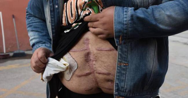 南京胖哥见义勇为失去肛门功能：脖子挂着造瘘袋，排泄就得换袋子休闲区蓝鸢梦想 - Www.slyday.coM