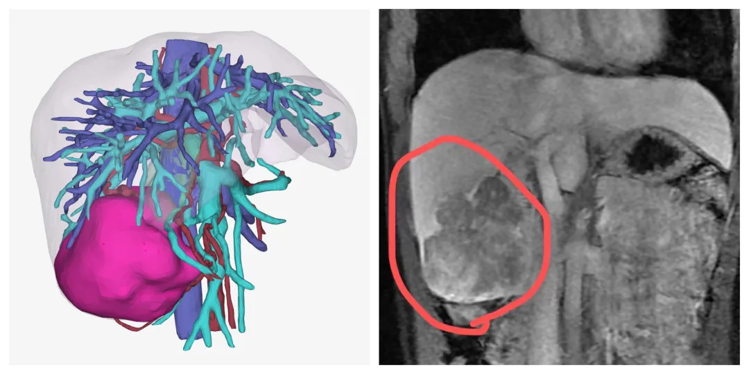 上热搜！22岁女子长期熬夜吃烧烤，查出肝癌切掉半个肝休闲区蓝鸢梦想 - Www.slyday.coM