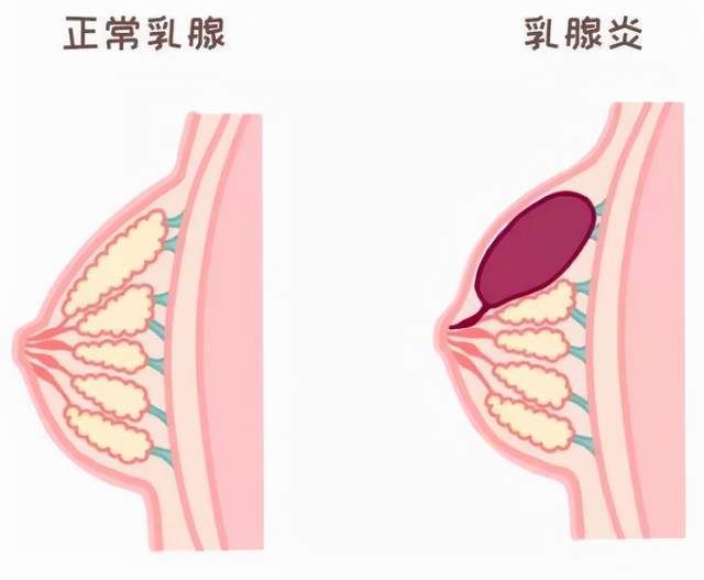 短期可能会把乳房淤积的乳汁给划开,如果吸了时间比较久,乳房硬块化不