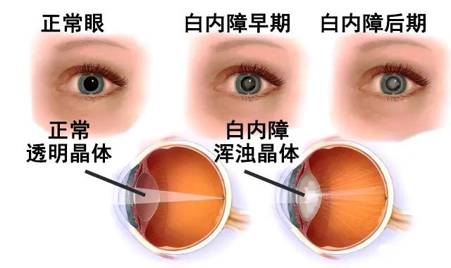 白内障是每个老年人都迈不过去的坎眼科专家表示其实