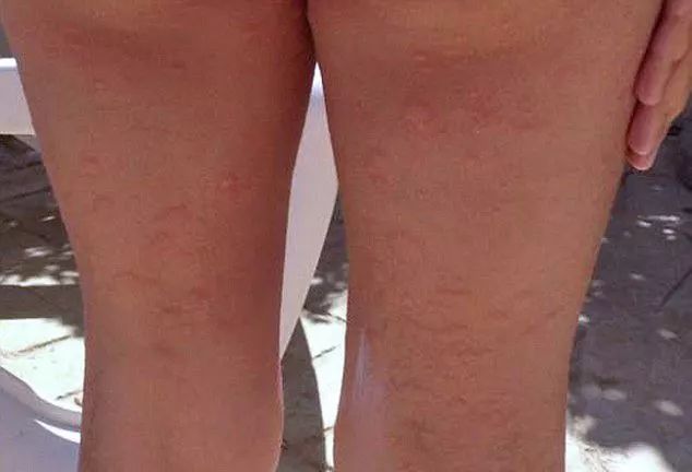 冬季宝宝高发皮肤病大盘点赶紧学习预防