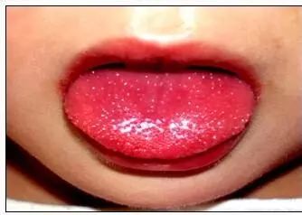 冬季宝宝高发皮肤病大盘点赶紧学习预防