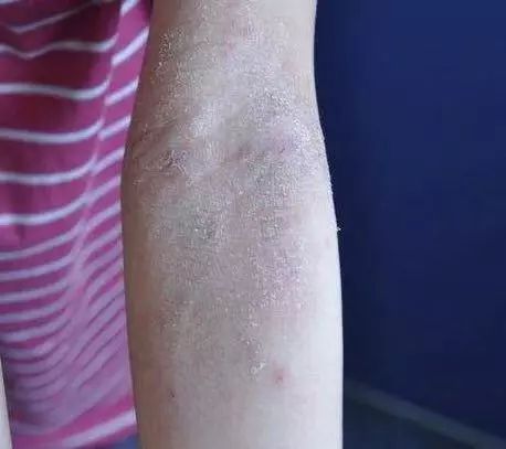 冬季宝宝高发皮肤病大盘点赶紧学习预防