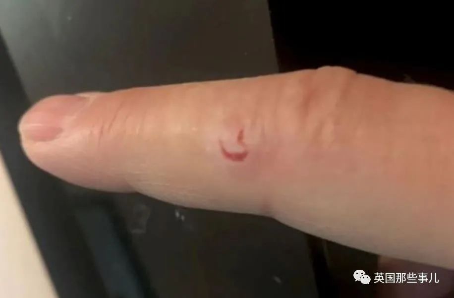 英国嗜血松鼠2天咬伤18人咬到出血最终被抓起来安乐死