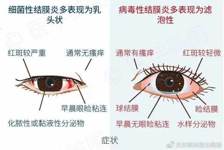 当球结膜下液体增多,或回流受阻时,球结膜就会水肿鼓起来,外观类似