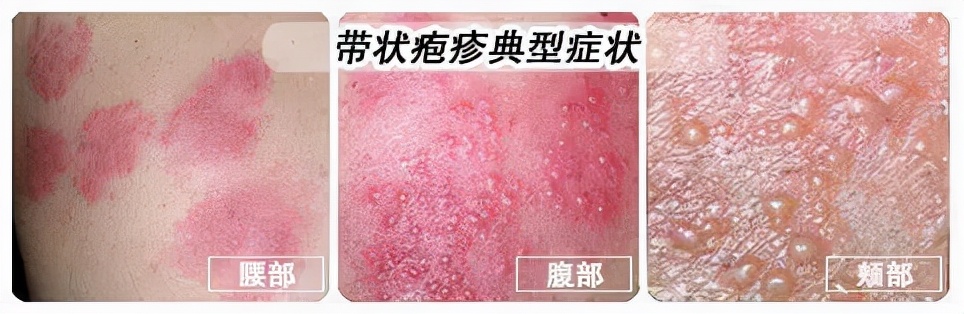 蛇缠腰找上门妈妈痛得彻夜难眠后悔没有早点儿打这个疫苗