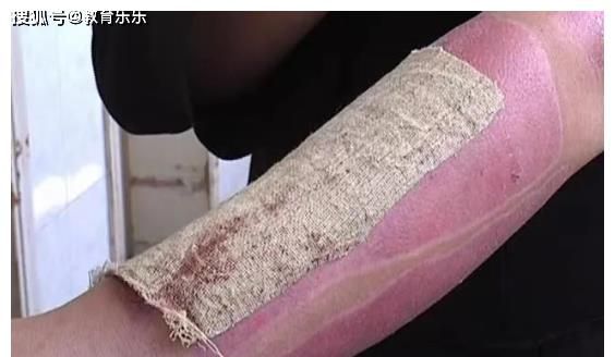 全身重度烧伤,妻子不惜割皮也要救|烧伤|袁志豪|割皮_新浪新闻