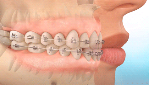 henry schein orthodonticsq那么,整牙会有哪些潜在风险存在呢?