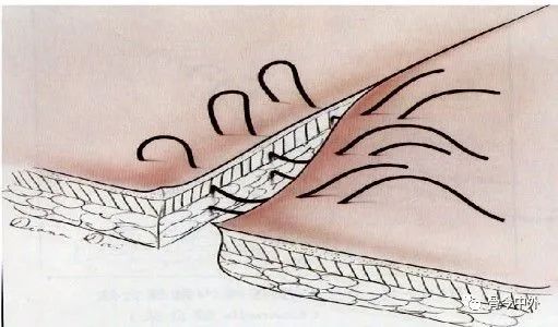 外科基本功简单易懂的十种缝合方式