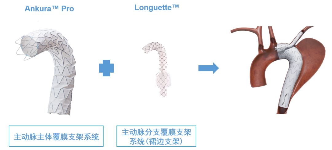 人支架最多几次手术