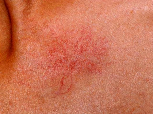 辟谣:这2种情况才需要注意|辟谣|蜘蛛痣|小红点_新浪新闻