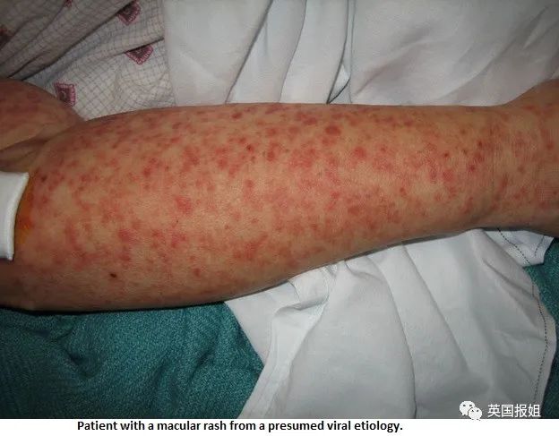 新冠病毒皮疹图片图片