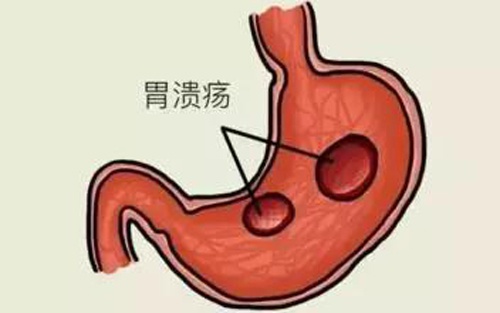胃溃疡,十二指肠溃疡是一种很严重的病吗?