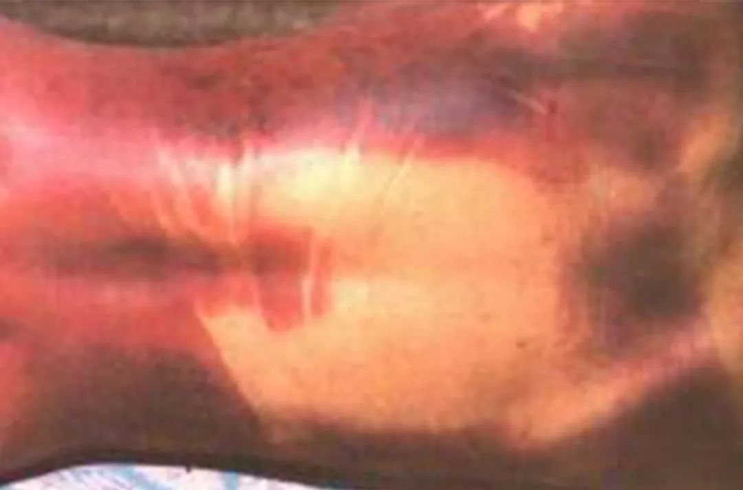 浸润期就变这样了▲左滑查看坠积期的尸斑长这样躺着死掉的尸体正常