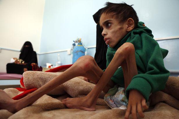 也门7岁男孩体重仅为14斤,饿殍遍地的地区民不聊生