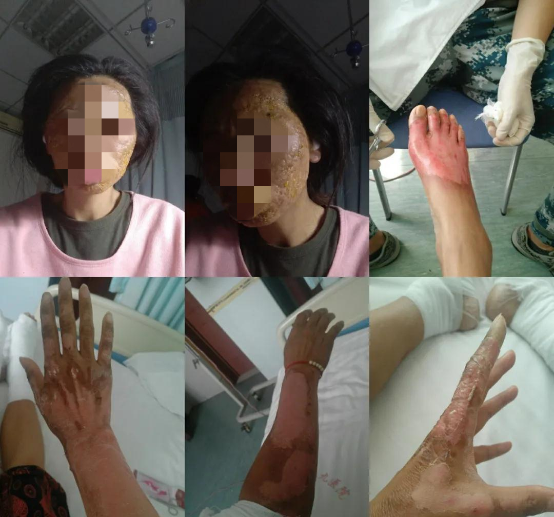 房车爆燃之后:昔日模特面部烧伤 7年翻12倍的市场"野蛮生长"