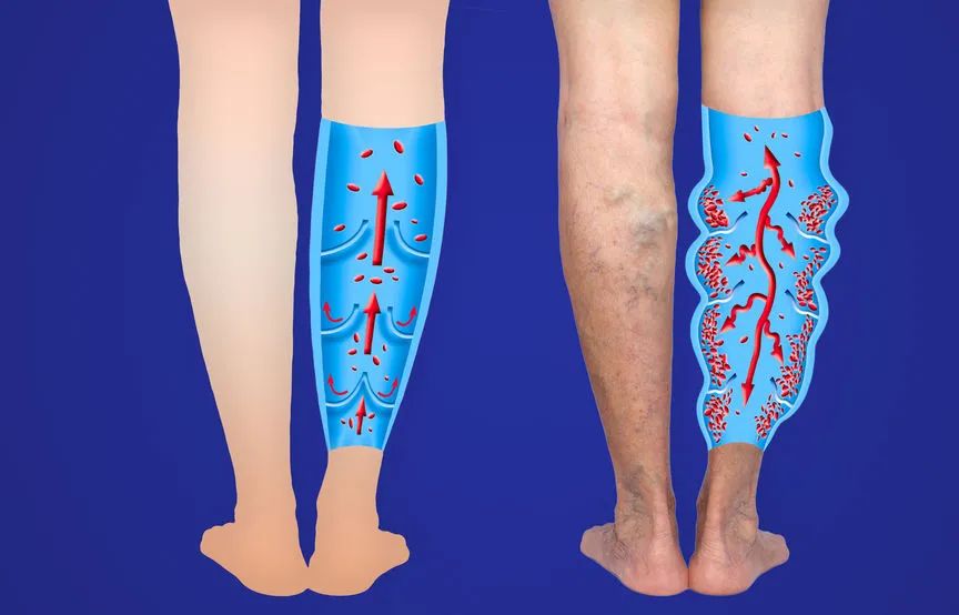 下到上回到心脏,必须通过小腿肌肉泵,下肢静脉瓣膜和胸腔内负压的作用