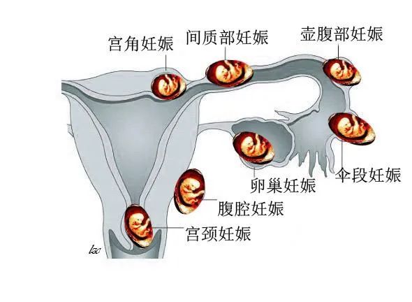 (各种宫外孕示意图)病情紧急危重,她马上报告了翟洪波主任医师,翟洪波