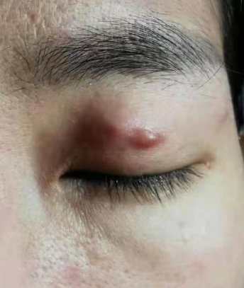 广西美女割双眼皮美容店老板上门服务切出增生还留疤